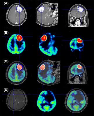 Correlation Between 18F-FDG Uptake and Immune Cell Infiltration in Metastatic Brain Lesions